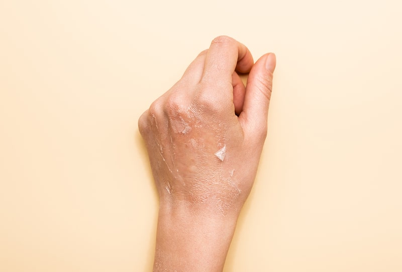 allergic-reaction-to-wet-wipes