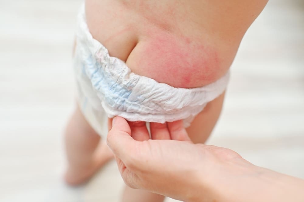 can wet wipes cause diaper rash