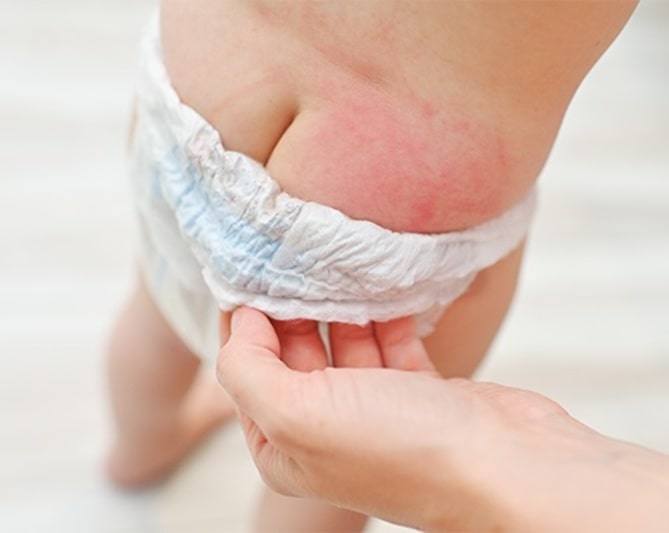 can wet wipes cause diaper rash